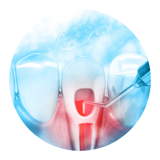 endodontic retreatment