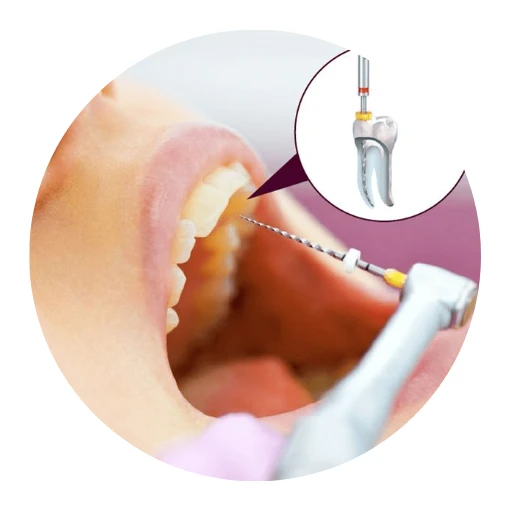 Sedation Dentist Concord NH apicoectomy
