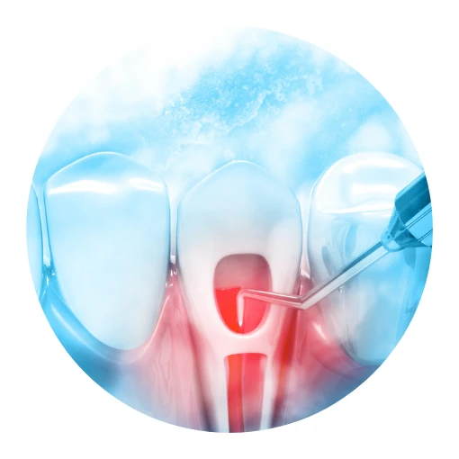 Sedation Dentist Concord NH endodontic retreatment